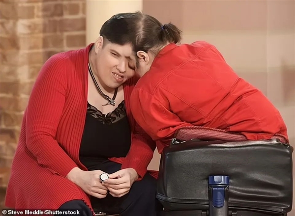 欧陆娱乐主管:美国最年长连体人62岁去世:妹妹46岁变性 支持姐姐结婚生子